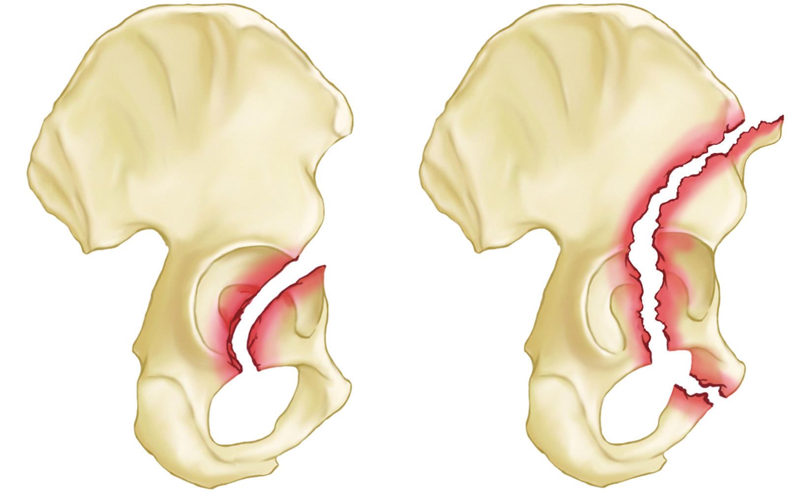 Acetabular fractures